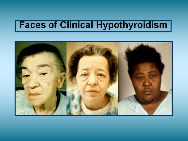 Faces of Clinical Hypothyroidism